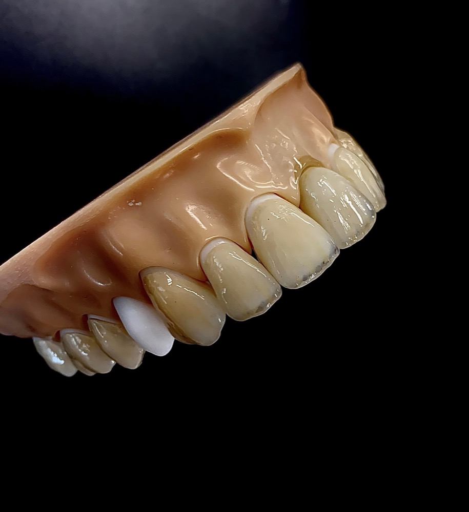 Keramikkronen und Veneers auf einem Oberkiefermodell