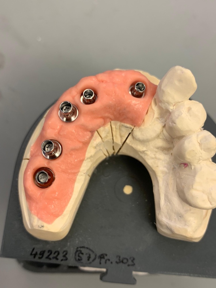 Implantatmodell mit Abutments